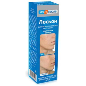 До и после лосьон анти-акне д/пробл. кожи 200мл. /твинс тэк/